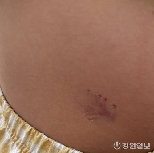 ◇김모(8)군은 지난달 19일 이웃집 반려견에게 공격을 당해 상처를 입었다. 사진=독자 제공