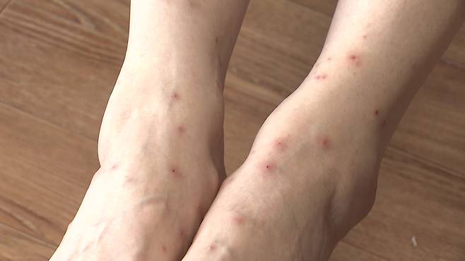 벼룩에 잇따라 물린 아파트 주민의 다리.