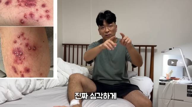 캄보디아 여행에서 저렴한 발 마사지를 받은 후 다리가 염증으로 뒤덮였다는 유튜버.  [유튜브 갈무리]