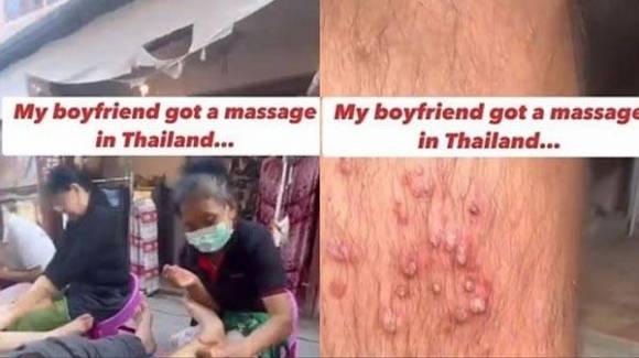 태국 여행 중 저가 마사지를 받은 뒤 다리에 심각한 염증이 생겼다는 남성의 영상이 확산하고 있다. SNS 캡처