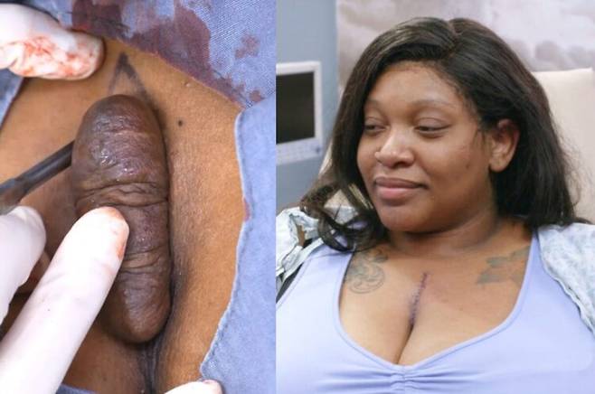 가슴에 '똥' 처럼 생긴 켈로이드 흉터로 인해 대인 기피증까지 겪었던 20대 여성이 성공적으로 흉터를 제거한 사연이 전해졌다. [사진=SNS]