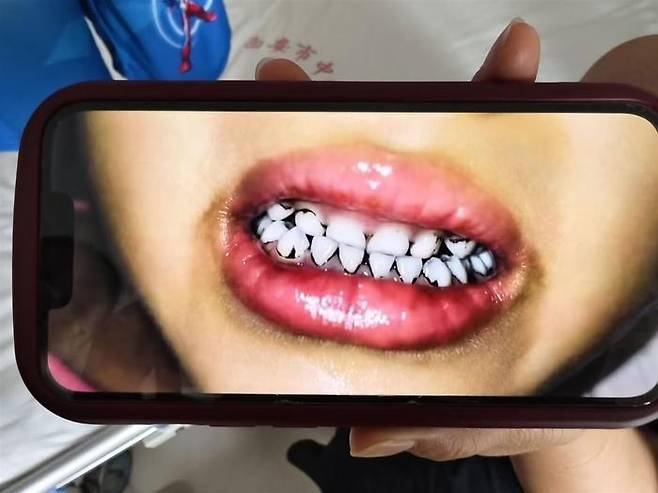 중국에서 납중독 의심으로 치아가 검게 변한 유치원생. 중국 매체 지무뉴스 캡처