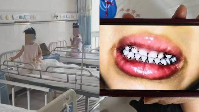 중국서 납중독 의심으로 병원에 입원한 유치원생들(왼쪽)과 치아 일부가 검게 변한 원생. 출처=웨이보