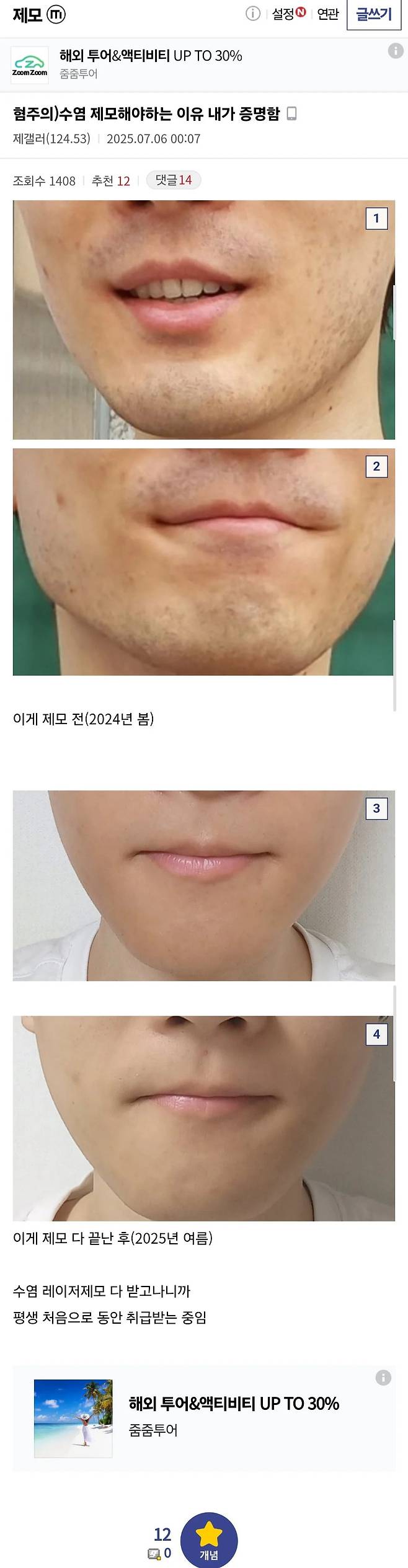 117cabd6a951285f3fc512e901f6941c.webp.ren.jpg 수염 레이저 제모해야하는 이유 알려주는 디시인.jpg