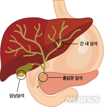 [서울=뉴시스]담석의 부위별 명칭과 위치. (이미지= 뉴시스DB) 2023.09.14. photo@newsis.com.