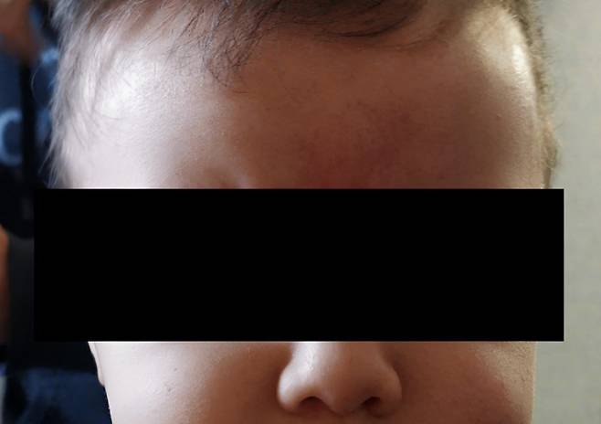 미국 아칸소에서 15개월 아기가 누나의 긴 머리카락에 목이 졸려 기절하는 사고가 발생했다. 빠른 응급조치로 무사히 회복했지만, 의료진은 긴 머리카락처럼 일상 속 물건도 영유아에겐 치명적일 수 있다며 주의를 당부했다. (사진=cureus)