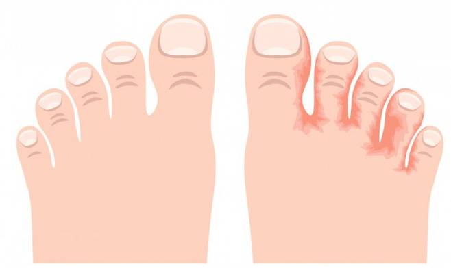 왼쪽은 정상적인 발, 오른쪽은 곰팡이 감염증인 무좀에 걸린 발을 나타냈다. 게티이미지뱅크 제공.