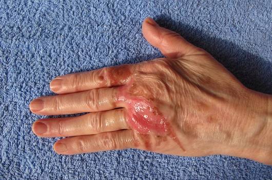 화상 입은 손ㅣ출처: 게티이미지 뱅크