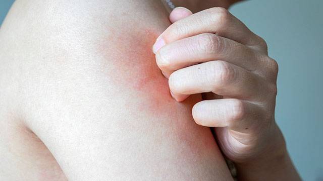 만성 피부 질환이 있다면 여름철 피부 관리에 신경써야 한다｜출처: 게티이미지뱅크