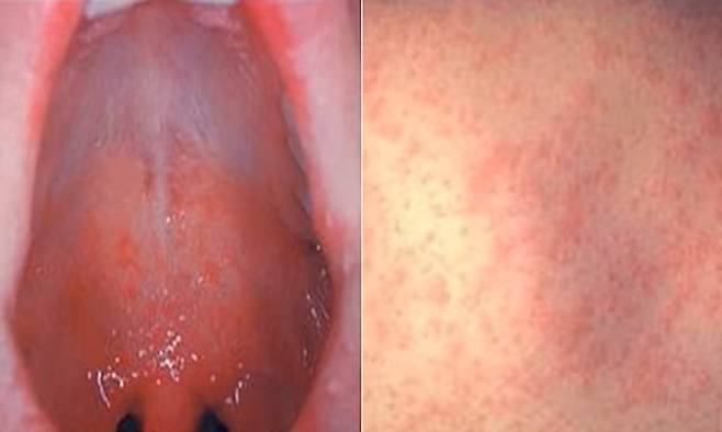 구강 내 반점과 피부 발진 등 홍역 증상. 질병관리청 제공