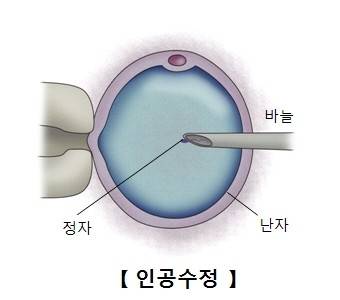 체외 수정 [서울아산병원 제공]