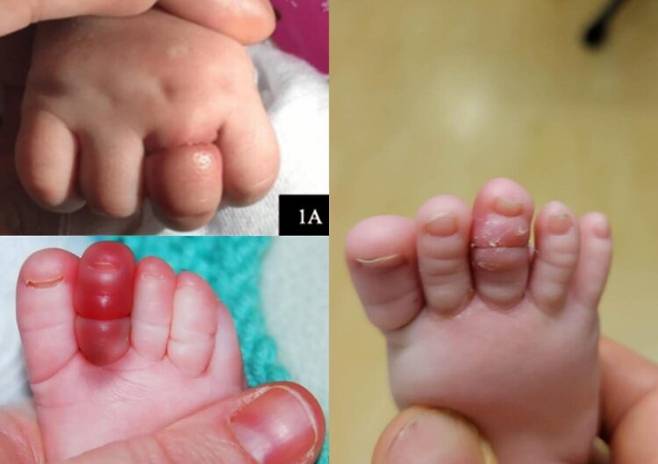 손가락, 발가락에 머리카락 등이 감기면 피부가 붉게 변하고 퉁퉁 부어오른다. [사진=SNS]