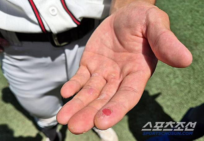 덕수고 3학년 좌완 에이스 김화중의 왼손 검지가 심하게 찢어져 있다. 투구할 때 고통스러웠지만, 오직 우승을 위해 본드를 발라가며 참고 던졌다. 목동=김민경 기자