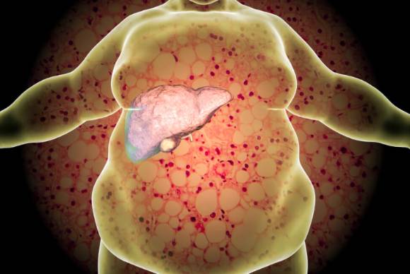 지방간을 태우는 운동법이 전문가에 의해 공개됐다. 사진은 본 기사 내용과 무관. [사진=Rocky Mountain Gastroenterology]