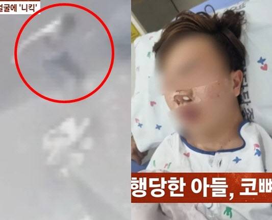술에 취한 남성이 지나가던 고등학생 3학년 A군은 폭행하고 있는 모습(왼쪽)과 폭행 후 병원 치료중인 A군 모습. /사진=JTBC '사건반장' 캡처