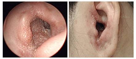 외이도염 환자 모습.사진=서울시보라매병원