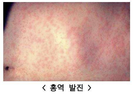 "홍역 조심…해외여행 후 3주내 발열·발진 시 병원 가세요" (서울=연합뉴스) 홍역 발진. 미국질병관리본부(Centers for Disease Control and Prevention) 사진을 질병관리청에서 재가공한 사진. 2025.05.07. [질병관리청 제공. 재판매 및 DB 금지]