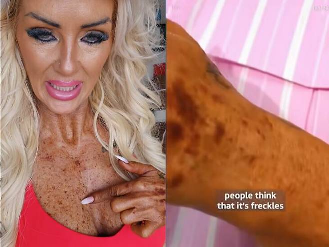 건강해 보이는 외모를 원해 십 수년 간 태닝 중독에 빠졌던 여성이 몸 곳곳에 피부 병변이 생긴 모습을 공개했다. 그는 평소 피부에 솟아오른 자국들을 갈아내어 관리를 한다고 밝혔다. [사진=SNS]