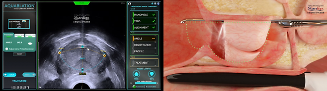 초음파 영상 가이드를 통한 정밀한 절제 경로 설정 모니터(왼쪽)와 아쿠아블레이션 고압 물줄기 분사 노즐이 전립선을 절제하는 모습.