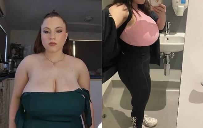 에이미 힐스(24)는 H컵 가슴 탓에 혼자 신발을 신기도 버거웠으며 샤워할 때 몸을 구부리는 것도 어려웠다. 딱 달라붙는 상의, 수영복, 단추 달린 옷 등도 입을 수 없었다. [사진=SNS]