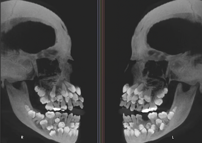 11세 소녀 입 안에서 치아가 무려 81개나 발견돼 학계에 충격을 주고 있다. VN익스프레스