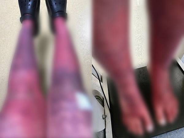 홍색사지통증(Erythromelalgia)과 복합부위통증증후군(CRPS)을 진단받은 한 영국 여성의 사연이 전해졌다./사진=데일리메일