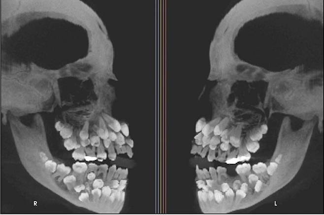 브라질 한 10대 소녀에게서 81개 치아가 발견됐다. [VN익스프레스]