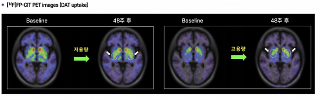 에스바이오메딕스가 개발 중인 파킨슨병 치료제의 효과를 확인한 연구 결과. TED 기술 기반 신경전구세포 치료 후 48주가 지난 파킨슨병 환자의 PET 영상에서 도파민 전달체(DAT) 흡수가 뚜렷하게 증가해 신경 기능 회복이 확인됐다. 에스바이오메딕스 제공