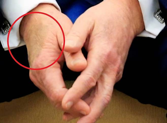 도널드 트럼프 미국 대통령의 손에 멍자국이 발견되며 건강이상설이 불거졌다. [로이터]