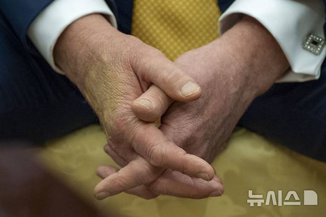 [워싱턴=AP/뉴시스] 지난 16일(현지 시간) 도널드 트럼프 대통령이 백악관 집무실에서 살만 빈 하마드 알 칼리파 바레인 왕세자 겸 총리와 회담하고 있다. 트럼프 대통령은 이날 손 멍 자국을 가리기 위해 화장품을 덧발랐다. 올해 79세인 트럼프 대통령이 종아리 붓는 증상으로 종합 검진한 결과 만성 정맥부전을 진단받았다. 2025.07.18.