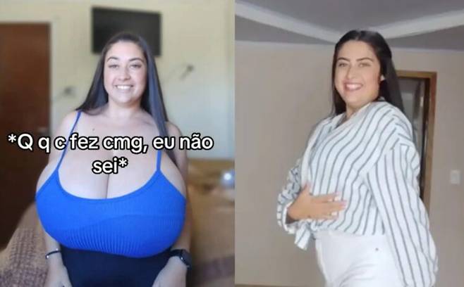 브라질의 한 22세 여성이 전 세계적으로 극히 드문 유방 질환을 앓다, 10시간에 걸친 유방 축소 수술로 약 10kg에 달하는 유방 조직을 제거한 사연이 알려졌다. 수술 전과 후(우측) 모습 [사진=SNS]