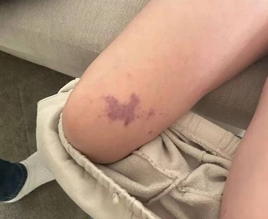 뇌수막염으로 인한 심각한 합병증으로 두 다리와 오른팔을 절단한 페넬로페 비달-월시(10) [데일리메일]