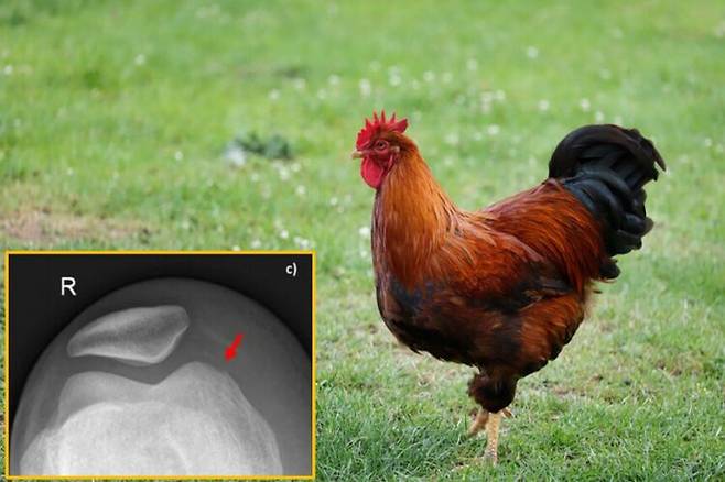 스위스에 사는 한 20대 여성이 닭에게 무릎을 쪼인 후 생명을 위협할 수 있는 심각한 관절 감염에 걸린 사례가 보고됐다. [배경사진=게티이미지뱅크/왼쪽 하단 사진='BMC Infectious Diseases']