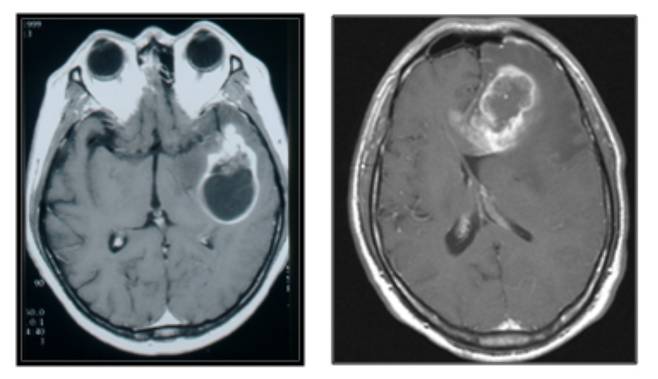 악성 뇌종양(교모세포종)의 MRI 촬영 검사 결과. /사진=서울대병원