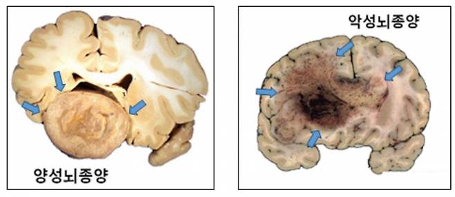 양성 뇌종양(왼쪽)과 악성 뇌종양(오른쪽) 병변 비교. /사진=서울대병원