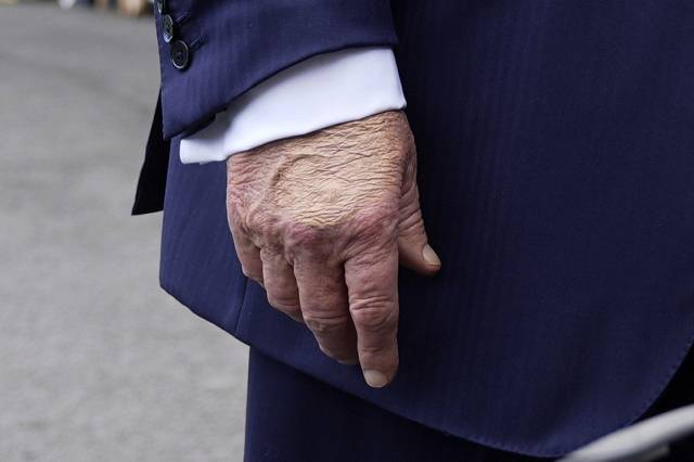 ▲지난 7월 15일 찍힌 트럼프의 손. 손등의 멍을 가리기 위해 화장품을 두껍게 바른 모습이 카메라에 잡혔다. ⓒAP=연합뉴스