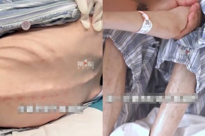 체중 감량을 위해 다이어트약을 하루 150~200알씩 먹은 중국 여성. 몸무게가 25㎏까지 줄고, 건강 상태가 악화해 병원에 입원했다. 더우인 캡처