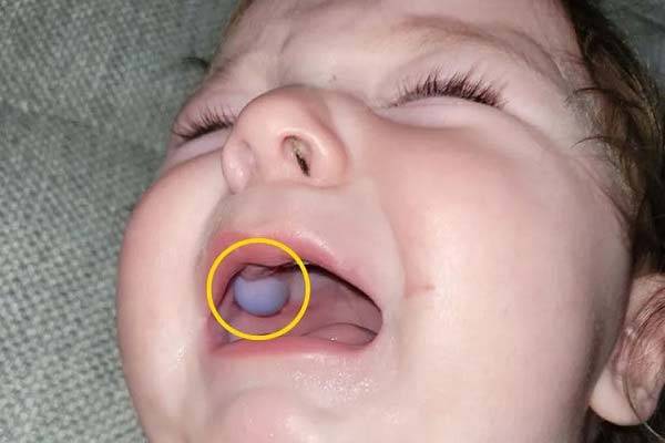 미국에서 9개월 아기가 촉감놀이 장난감을 만지다가 입안에 넣어 잇몸에 달라붙은 사고가 발생했다.​/사진=피플