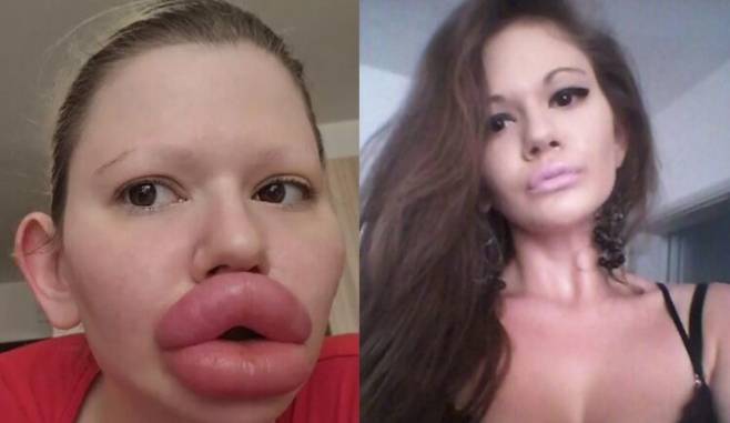 입술 필러 시술로 '세계에서 가장 큰 입술'을 갖고자 한 여성이 등장해 관심과 함께 우려를 낳고 있다. 오른쪽 사진이 입술 시술 전 모습 [사진=안드레아 SNS]