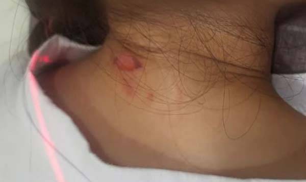 청주의 한 초등학교 교사가 학생들의 맨살에 드라이아이스를 갖다 댄 뒤, 동상을 입히며 아동 학대 혐의로 신고 당했다./사진=MBC충북 화면 캡처