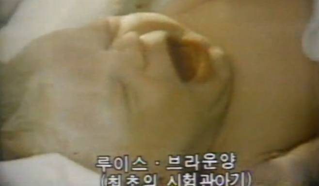1978년 7월 25일 영국 올덤 종합병원에서 세계 최초의 '시험관 아기' 루이스 브라운이 태어났다. 출산은 비공개로 진행된 가운데, 사전 촬영된 일부 영상만 언론에 공개됐다. 불임 여성이 시험관 시술을 통해 임신해 출산한 것임을 입증하기 위해 제왕절개 수술 장면과 산모의 나팔관 이상을 보여주는 장면이 담겼다. /사진=MBC 뉴스 방송 화면