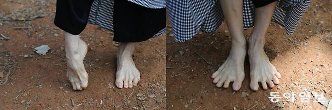 원종연 씨가 과거 소아마비 지체 장애 시절 발 모양을 흉내 냈다.(왼쪽 사진) 오른쪽 사진은 원종연 씨의 현재 발 모습.