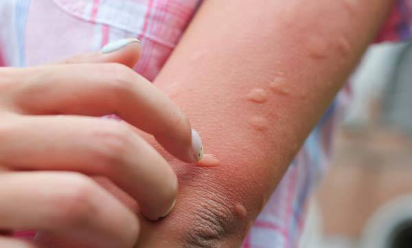 모기에 물린 뒤 유난히 부기가 심하고 통증까지 동반된다면 ‘스키터증후군’일 수 있다./사진=클립아트코리아