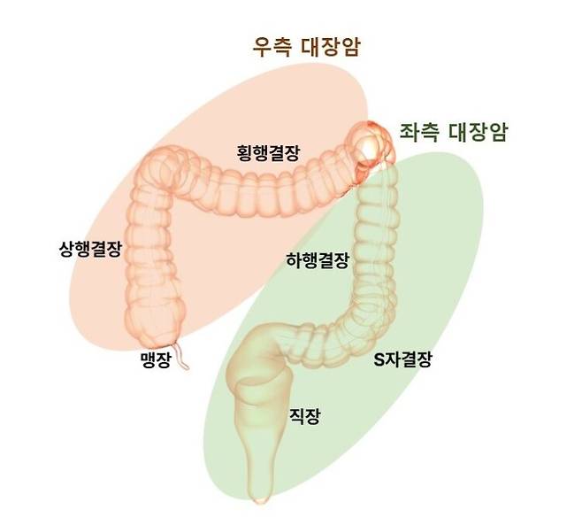정면에서 바라본 대장암의 위치별 분류. [사진=분당서울대병원]