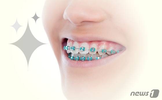 (서울=뉴스1) 강승지 기자 = 방학 기간 평소 미뤄왔던 자녀의 치아교정을 시작하려는 부모가 많다. 아이들은 치료 초기 교정 장치에 적응하는 데 오랜 시간이 걸리는데, 방학은 치료와 학습을 병행할 수 있는 적기다. ⓒ News1