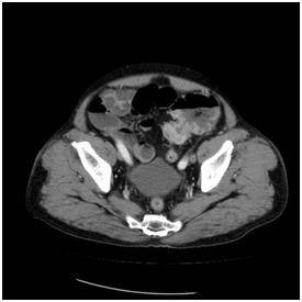 대장암으로 장폐쇄가 생겨서 유발된 변비 [서울대병원 제공]