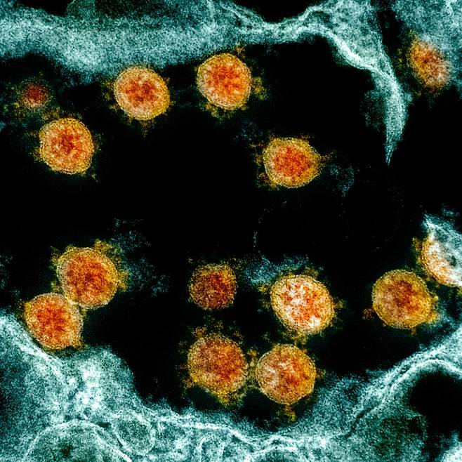 인체 호흡기에 감염된 코로나 바이러스(주황색)의 전자현미경 사진. 코로나바이러스가 휴면 상태의 암세포까지 깨우는 것으로 밝혀졌다./NIAID
