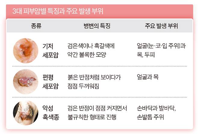 3대 피부암별 특징