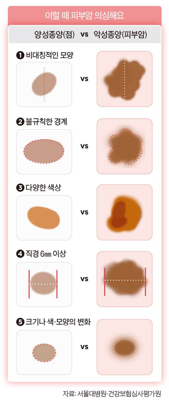 양성종양과 악성종양의 차이