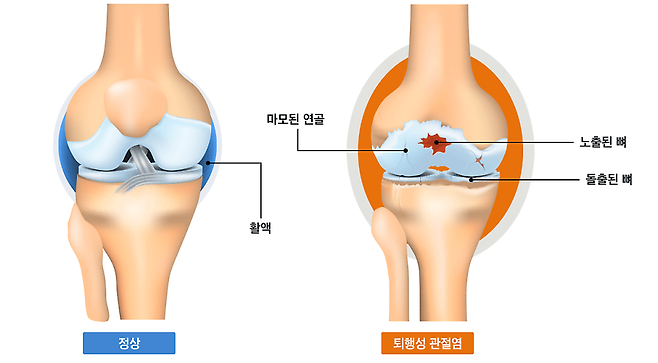 연골은 퇴행성 변화나 외상 등의 이유로 손상되면 자연 회복이 어려워 무릎 퇴행성 관절염 등의 질환 치료를 위한 연골 재생 기술은 의료계의 숙제였다. 가톨릭대 서울성모병원 제공